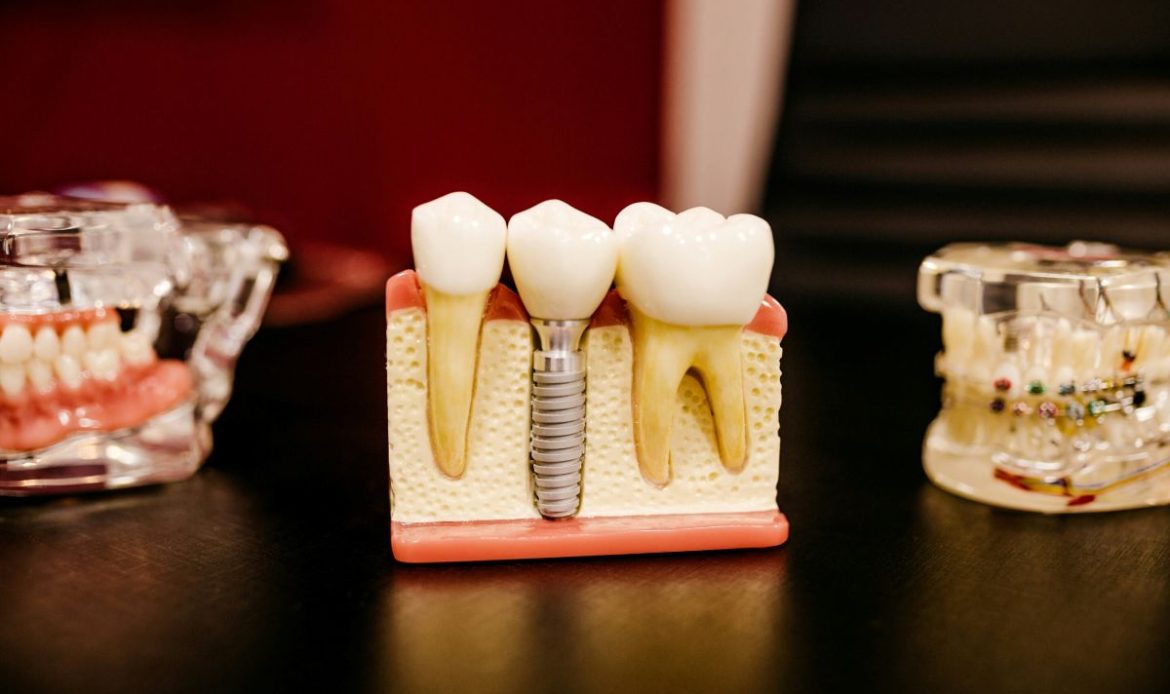 Ankarada Ileri Teknoloji Dis Tedavileri Ile Dental Implant Nasil Yapiliyor 1