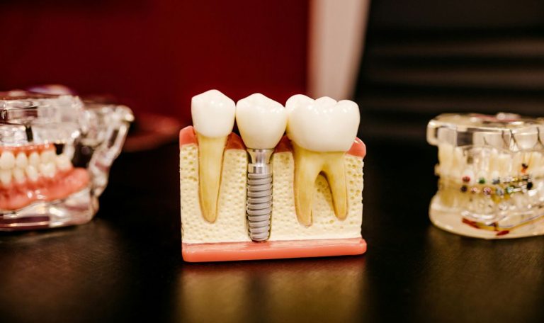 Ankarada Ileri Teknoloji Dis Tedavileri Ile Dental Implant Nasil Yapiliyor 1
