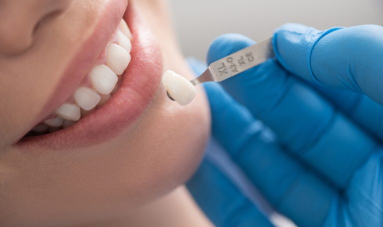 Ankarada Laminate Veneer Hizmeti Secerken Dikkat Edilmesi Gereken 7 Kriter