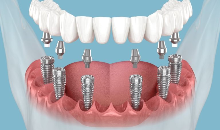 Cene Kemigi Erimesi Olan Hastalarda Implant Tedavisi Nasil Planlanir