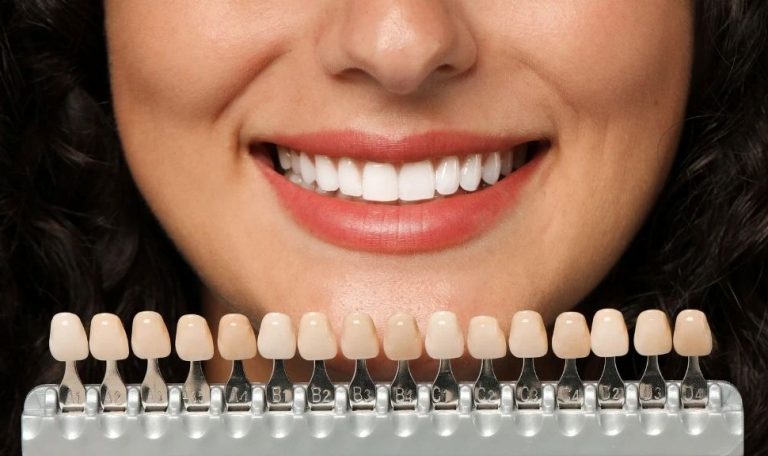 Dis Kaplama Turleri Nelerdir Hangi Kaplama Daha Avantajlidir