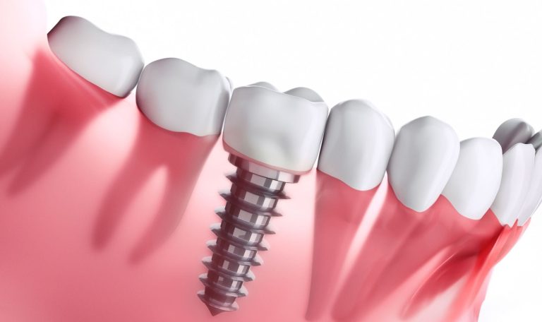Dogal Gorunumlu Gulusler Icin Implant Teknolojileri