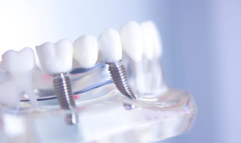 Implant Olmadan Gulus Tasarimi Yapilabilir Mi