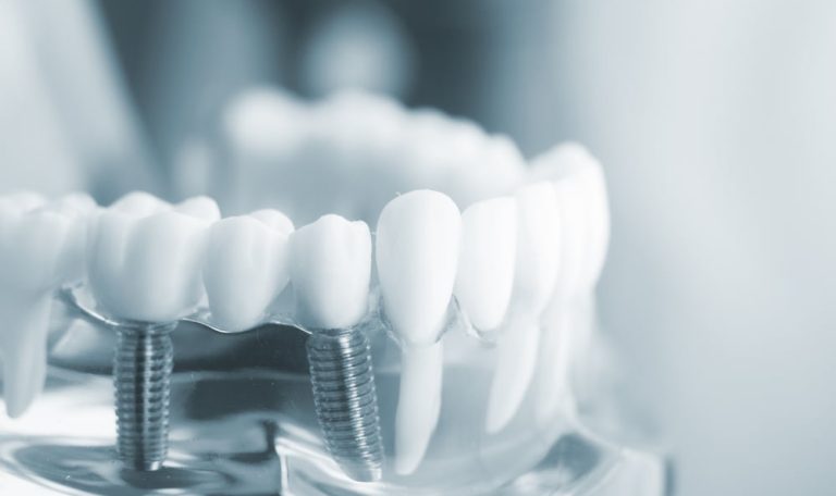 Implant Tedavisi Gulus Estetigini Ne Kadar Degistirir
