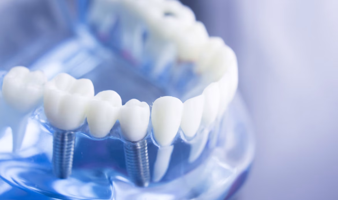 Implant Tedavisi Sonrasi Agri Normal Mi Neler Yapilabilir