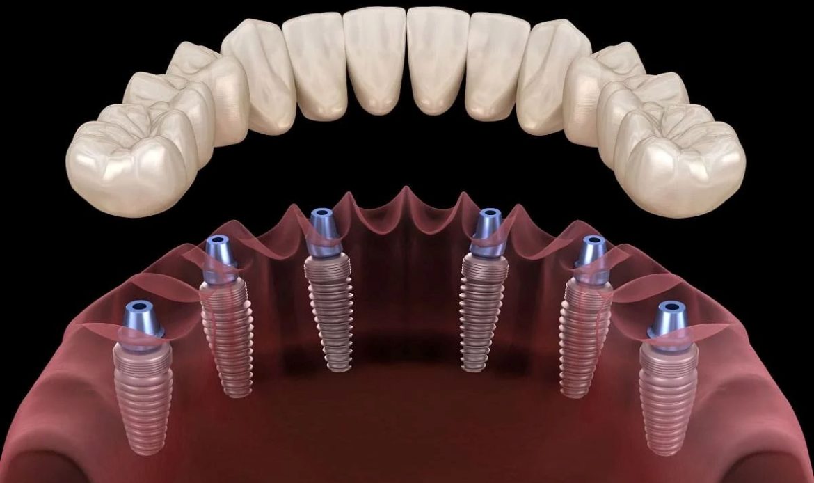 Implant Tedavisinde Yapilan Hatalar Nelerdir