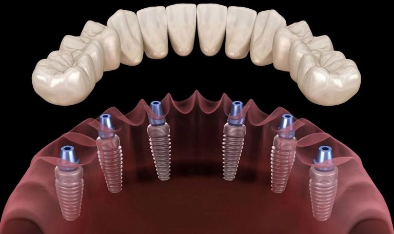 Implant Tedavisinde Yapilan Hatalar Nelerdir