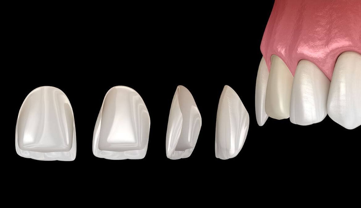 Laminate Veneer Dis Kaplama Fiyatlari Neye Gore Degisir