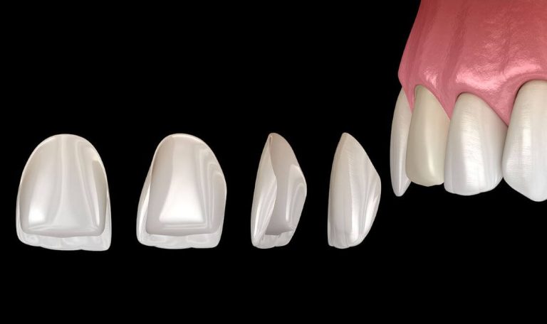 Laminate Veneer Dis Kaplama Fiyatlari Neye Gore Degisir