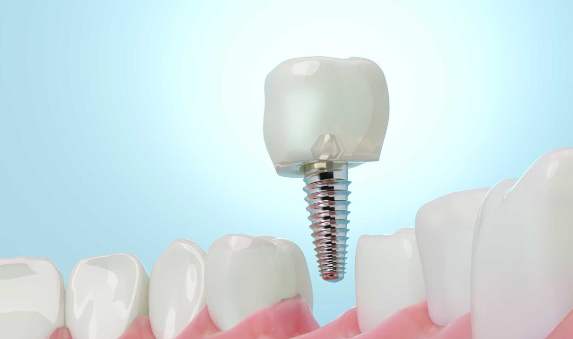 Implant Sonrasi Sislik Ve Odem Normal Mi Nasil Azaltilir