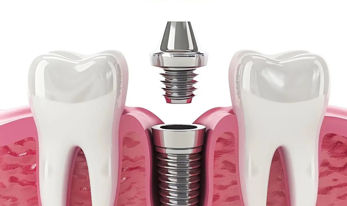 İmplant Mı Köprü Mü? Hangi Tedavi Daha Avantajlı? 1 Implant Mi Kopru Mu Hangi Tedavi Daha Avantajli