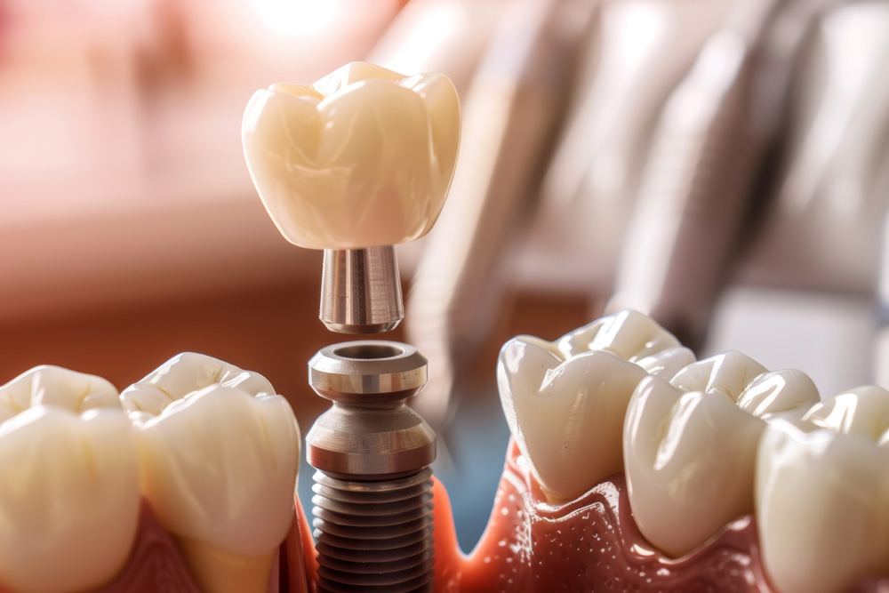 Uygun Fiyatli Dental Implant Ile Kaliteli Hizmet Mumkun Mu