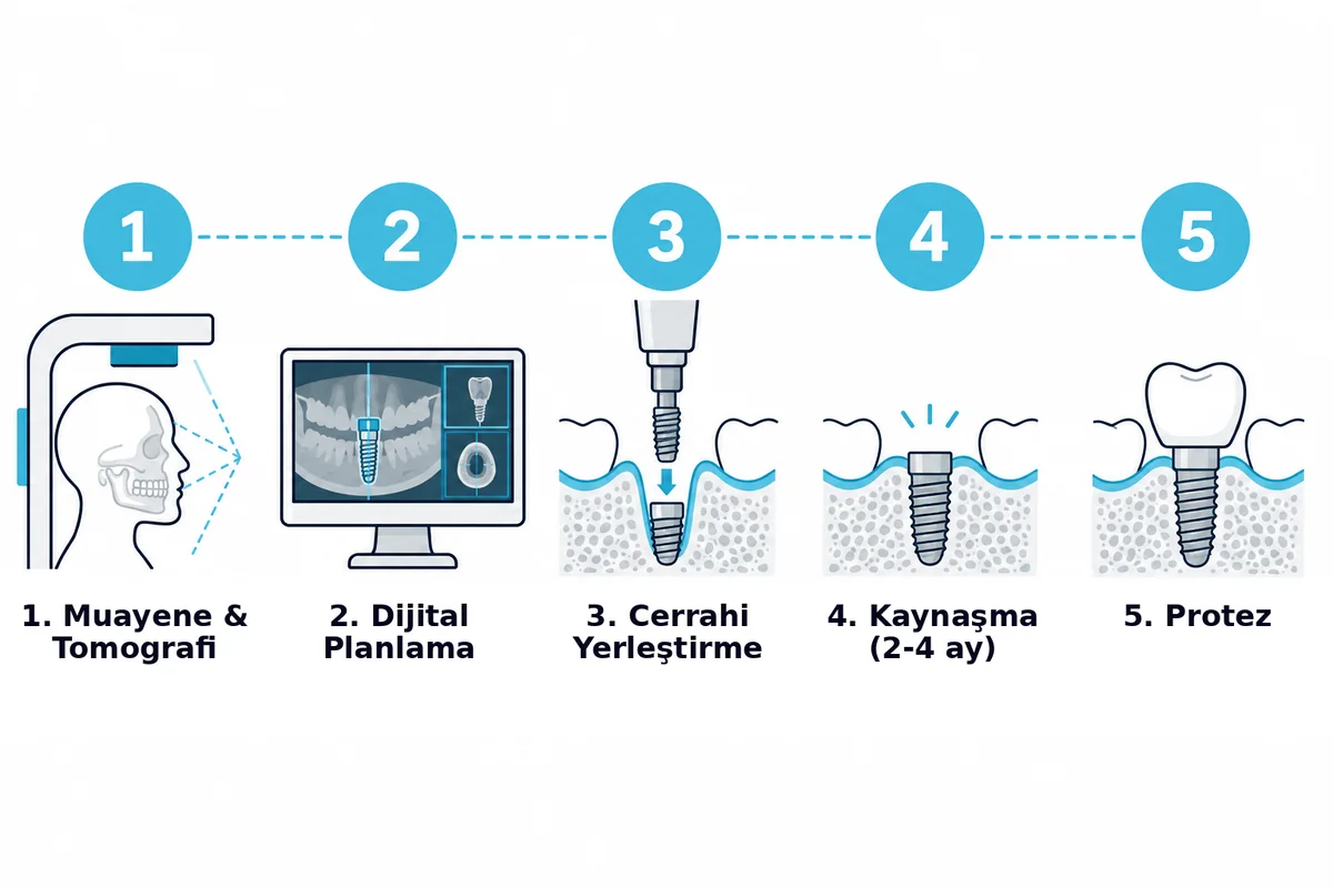Diş implantı tedavisinin muayene, planlama, cerrahi, iyileşme ve protez aşamalarını gösteren adım adım süreç şeması