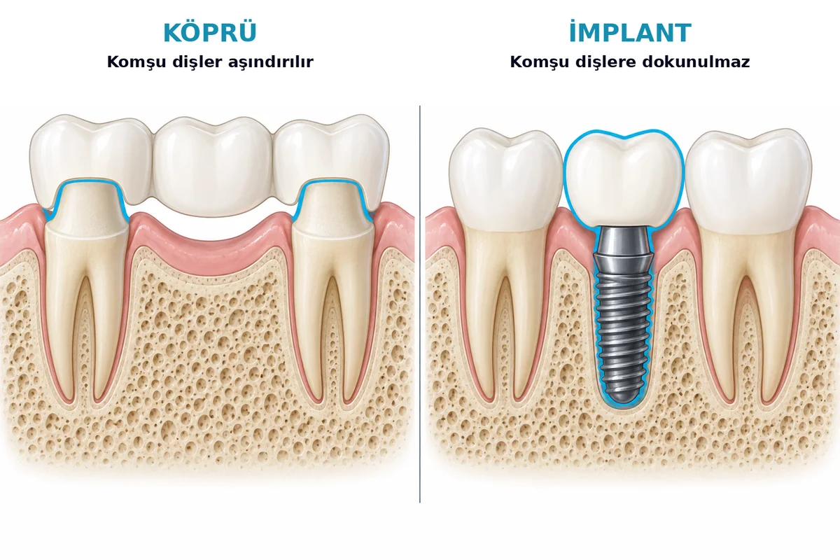 Köprü için komşu dişlerin aşındırılması ile implantın komşu dişlere dokunmamasını karşılaştıran şema